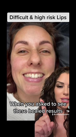 Lip Filler Gone Wrong: Before & After Healing Process