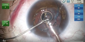 Ectopia Lentis - Eyetube