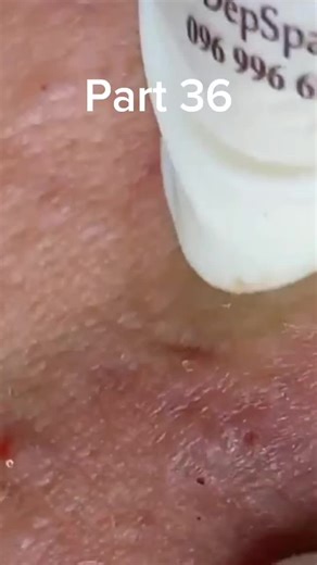 Effective Home Remedies for Blackhead Removal