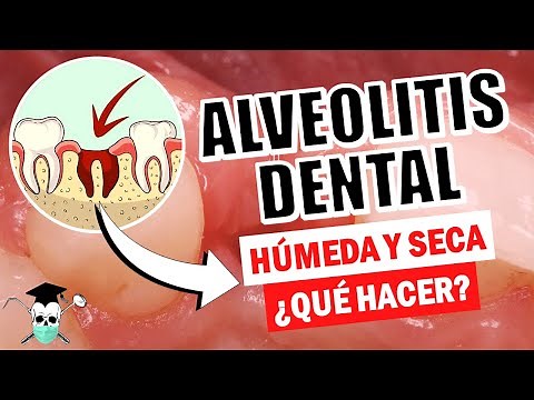 Dry Socket: What Should I Do? *Causes and Solutions*