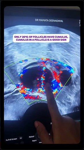 Understanding the Cumulus: A Sign of Egg Maturity in IVF | Mamata Fertility Hospital: Hyderabad