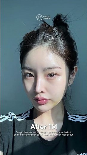 Facial Contouring Surgery Recovery Before & After