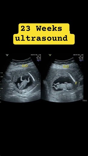 23 weeks pregnancy ultrasound scan baby kick in mother belly ♥️ #baby #ultrasound #cutebaby #