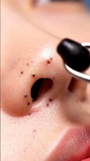 “Satisfying Blackhead Extraction You Can’t Look Away From 😳”