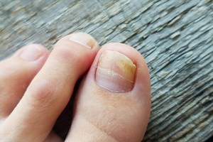 Fungal Nail Infection (Onychomycosis): Symptoms & Treatment in Singapore