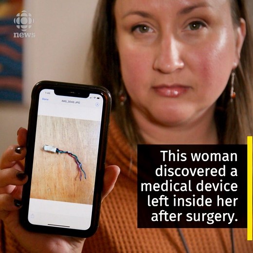 47K views · 433 reactions | More than 550 objects have been unintentionally left in Canadian medical and surgery patients between 2016 and 2018. The problem appears to be getting worse. Read more: https://www.cbc.ca/1.5349111 | CBC News | Facebook