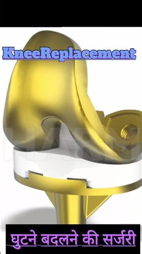 knee Replacement surgery#tkr