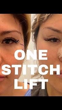 One Stitch Lift™ (SCARLESS FACE LIFT!)