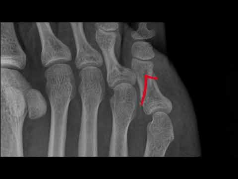 5th Toe Proximal Phalanx Fracture (Xray 52)