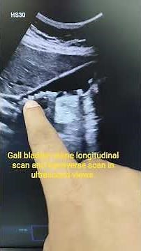 Gall bladder stone longitudinal scan and transverse scan in ultrasound views. #ultrasound