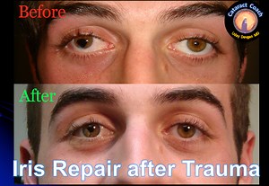 4 Cases of Surgical Iris Repair