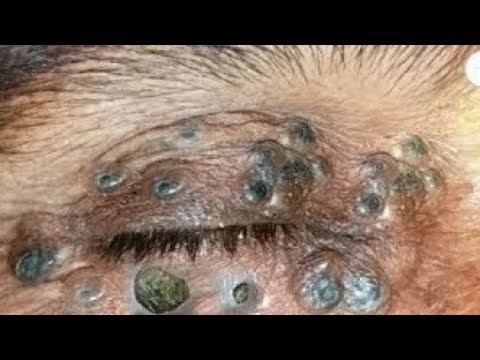 Best Satisfying Blackheads Removal PHD 13