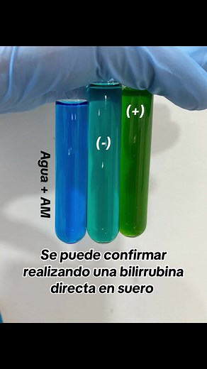 Pruebas y diagnóstico de bilirrubinas en orina