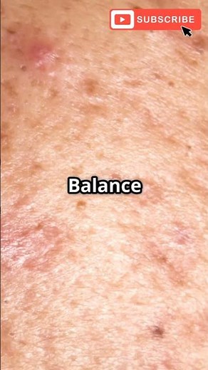 Cutibacterium acnes: Friend or Foe for Your Skin?