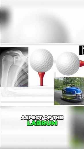 Shoulder Pain Explained - SLAP Tears & MRI Insights!