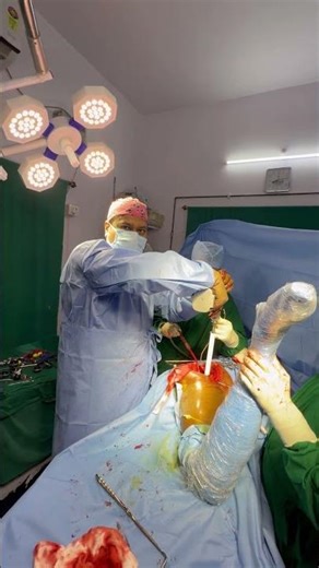 Central Reaming step of acetabulum preparation during uncemented THR