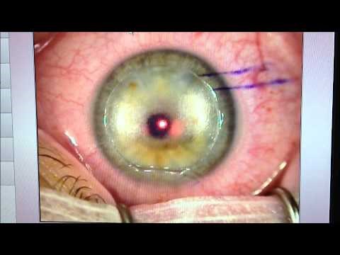 LASIK : myopie 10 Dioptries: photoablation laser excimer Wavelight EX500