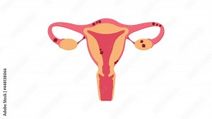Uterus with endometriosis 2D animation on transparent background. Fertility, human anatomy, female reproductive system. Disease, gynecology, inflammation. Outside tissue growth medical condition