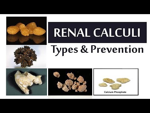 Renal Calculi -Types and Prevention