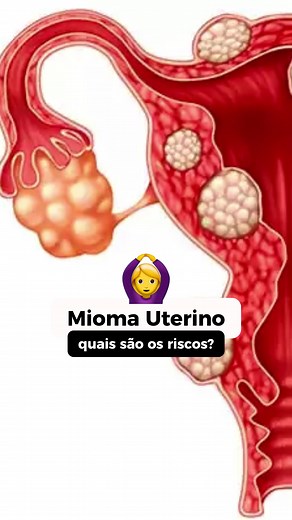 Mioma Uterino: Tudo que Você Precisa Saber