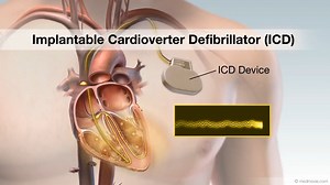植入式心律转复除颤器（ICD）