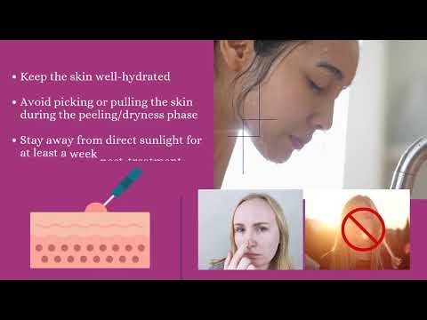 Electrolysis wart removal