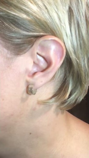 How to insert a In the Ear (CIC or ITE) Hearing Aid