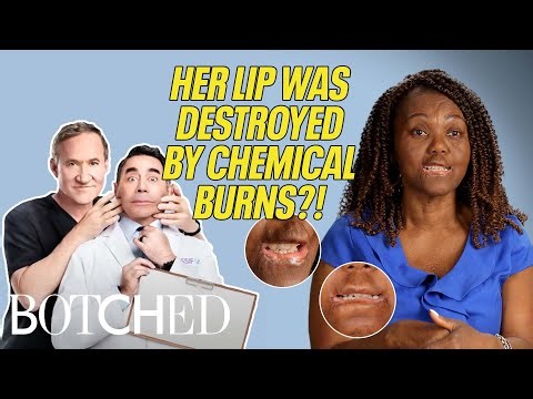 Jannie's Lip DISINTEGRATED After Being Fed Chemicals As A Baby?! (Before & After) | Botched | E!