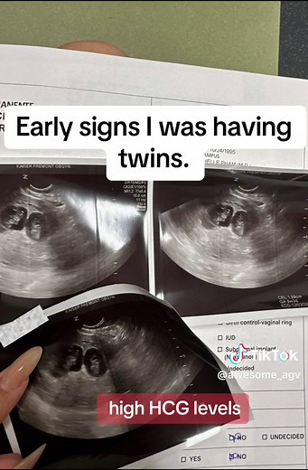 Early Signs of Twin Pregnancy: Symptoms & Journey