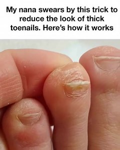 The Tried-and-True Trick for Reducing Thick Toenails | Mind At Peace