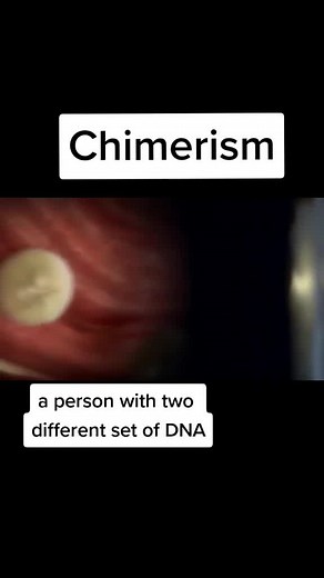 Yes,The condition is real #medical #medicine #medicineexplained #medschool #surgery #education #learnontiktok #edutok