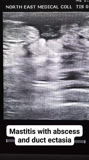 7.6K views · 135 reactions | #mastitis #sonographiccasestudy #radiology #usgscan #reelsvideo #reelsfacebook #ultrasound | Sonographic case study | Facebook