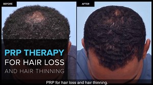 PRP for Hair Loss and Hair Thinning
