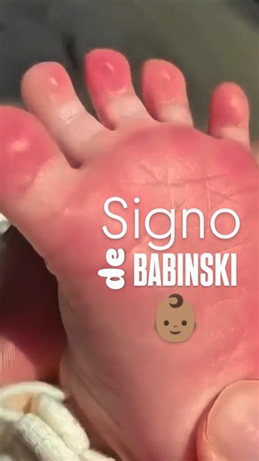 Dr. Carmona, supongo on Instagram: "El signo de Babinski es uno de los reflejos más importantes en el recién nacido y forma parte del neurodesarrollo normal durante los primeros meses de vida. Se produce cuando se estimula la planta del pie del bebé y el dedo gordo se extiende hacia arriba. Este reflejo es fisiológico en neonatos y lactantes porque el tracto corticoespinal aún no está completamente mielinizado. A partir de los 6 meses suele desaparecer progresivamente. En adultos, sin embargo, e