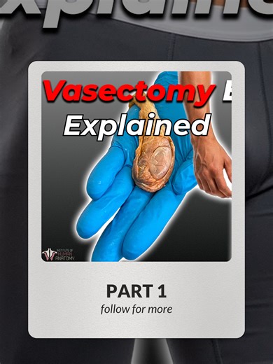 Understanding the Vasectomy Procedure: What Happens?
