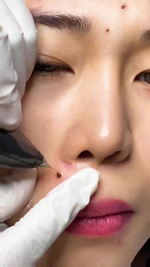 Effective Laser Mole Removal: Before & After Results Revealed!