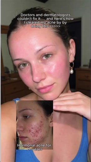 went from cystic acne to a 92 skin score im actually crying | skin