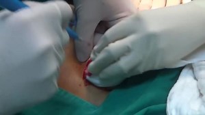 Аппендэктомия – смотреть видео онлайн в Моем Мире | Врачи Кыргызстана