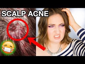 SCALP ACNE & ITCHY DANDRUFF | How To Get Rid of It Completely!