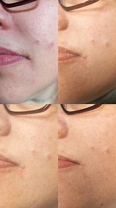 ❄️ 𝗖𝗿𝘆𝗼 𝗣𝗲𝗻 𝗧𝗿𝗮𝗻𝘀𝗳𝗼𝗿𝗺𝗮𝘁𝗶𝗼𝗻 ❄️ A simple, precise treatment option for unwanted skin lesions. Only TWO treatments and the results speak for themselves. Here’s a look at this clients Cryo Pen progress over two sessions. 𝗖𝗿𝘆𝗼 𝗣𝗲𝗻 𝗿𝗲𝘀𝘂𝗹𝘁𝘀 𝗼𝘃𝗲𝗿 𝗮 𝟰-𝘄𝗲𝗲𝗸 𝘁𝗿𝗲𝗮𝘁𝗺𝗲𝗻𝘁 𝗽𝗹𝗮𝗻: • Before (Images 1–2) • Post-treatment review at 2 weeks (Images 3–5) • Final results after the second session (Images 6–7) So impressed with this progress! ❄️ We tracked progres
