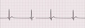 19K views · 166 reactions | Identify the following rhythm (see 6-second rhythm strip): Rhythm: Regular Rate: <60 beats/min QRS: Normal P waves: Uniform and precede each QRS complex | Nursing and NCLEX Mastery | Facebook