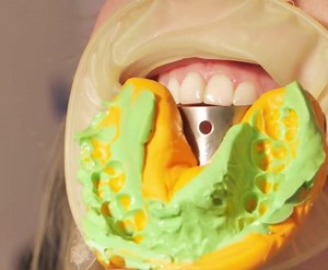 超專業牙套製作過程！ | 5分鐘diy