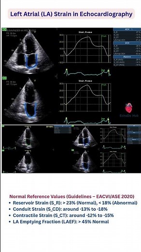 Left Atrial (LA) Strain in Echocardiography #baby #heartdisease