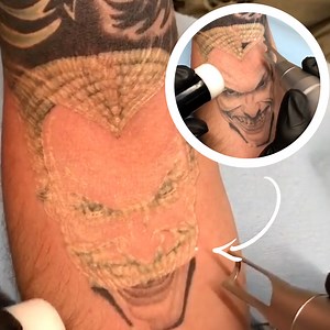 If only having a tattooed removed was as easy as it is to watch! 😅 | VT