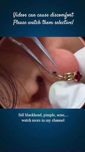 Big pimple blackhead removal #acne #pimple #blackhead #extractions #satisfying