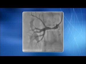 Chapter 15: TRA for addressing Renal Artery Stenosis