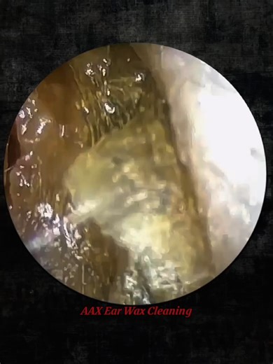 AAX Ear Wax Cleaning on TikTok