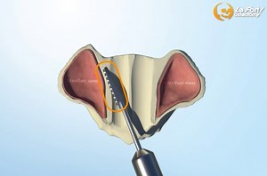 LeFort I Surgical Animation