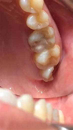 Wisdom tooth!!! #drfaiquaanwar #calculusslayer #dentist #teeth #wisdomtooth