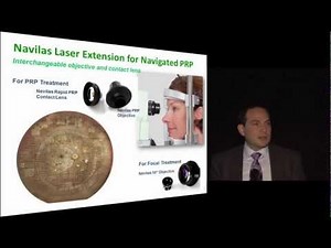 Navilas® Laser for Panretinal Photocoagulation - by Michael Ober
